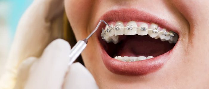 Benefits Of Regular Teeth Cleaning To Overall Health
